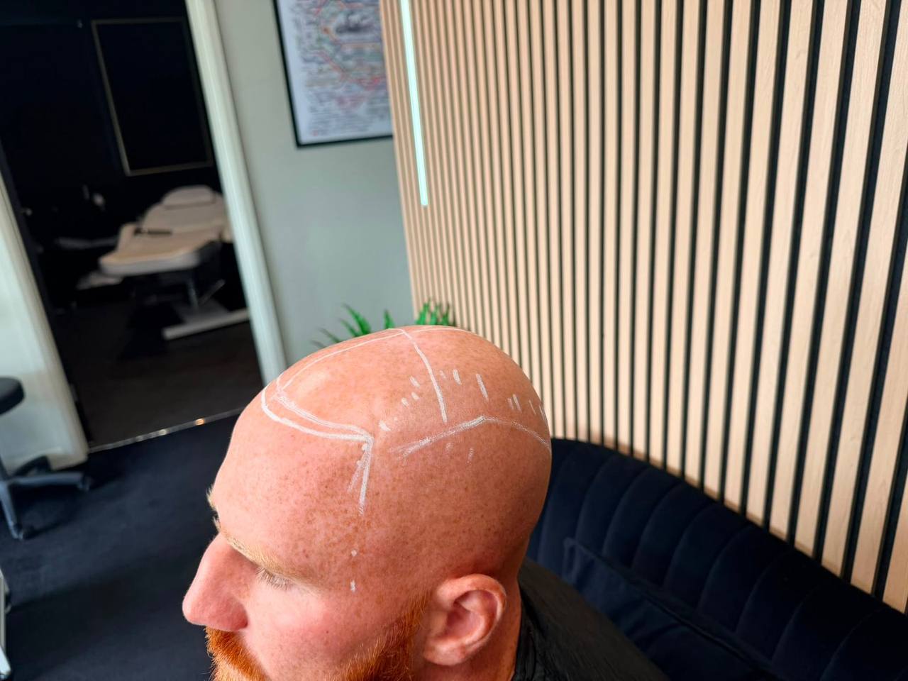 Crown and hairline mapped out in white pencil before a scalp micropigmentation session
