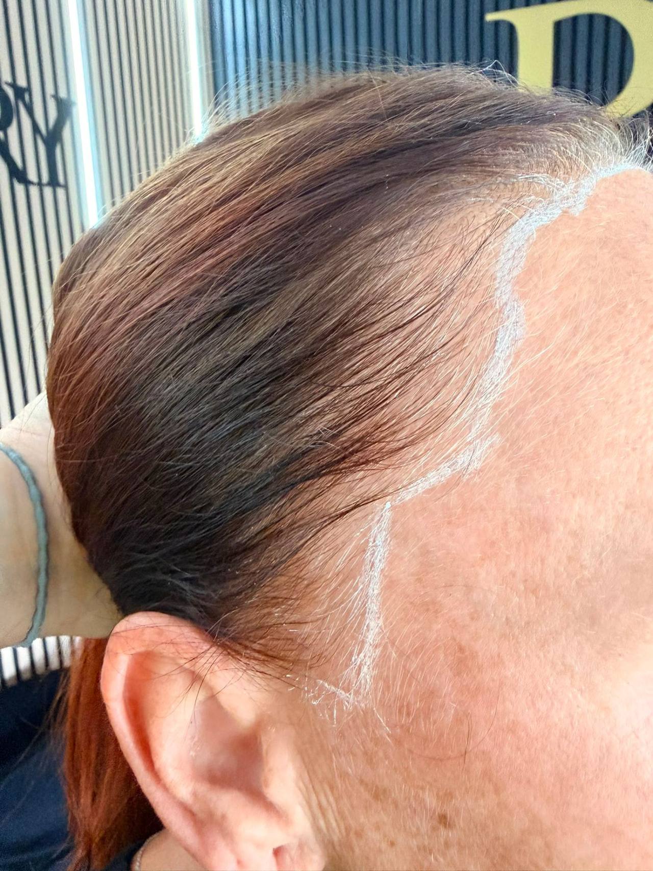 Female hairline restoration with scalp micropigmentation density work through thinning hair