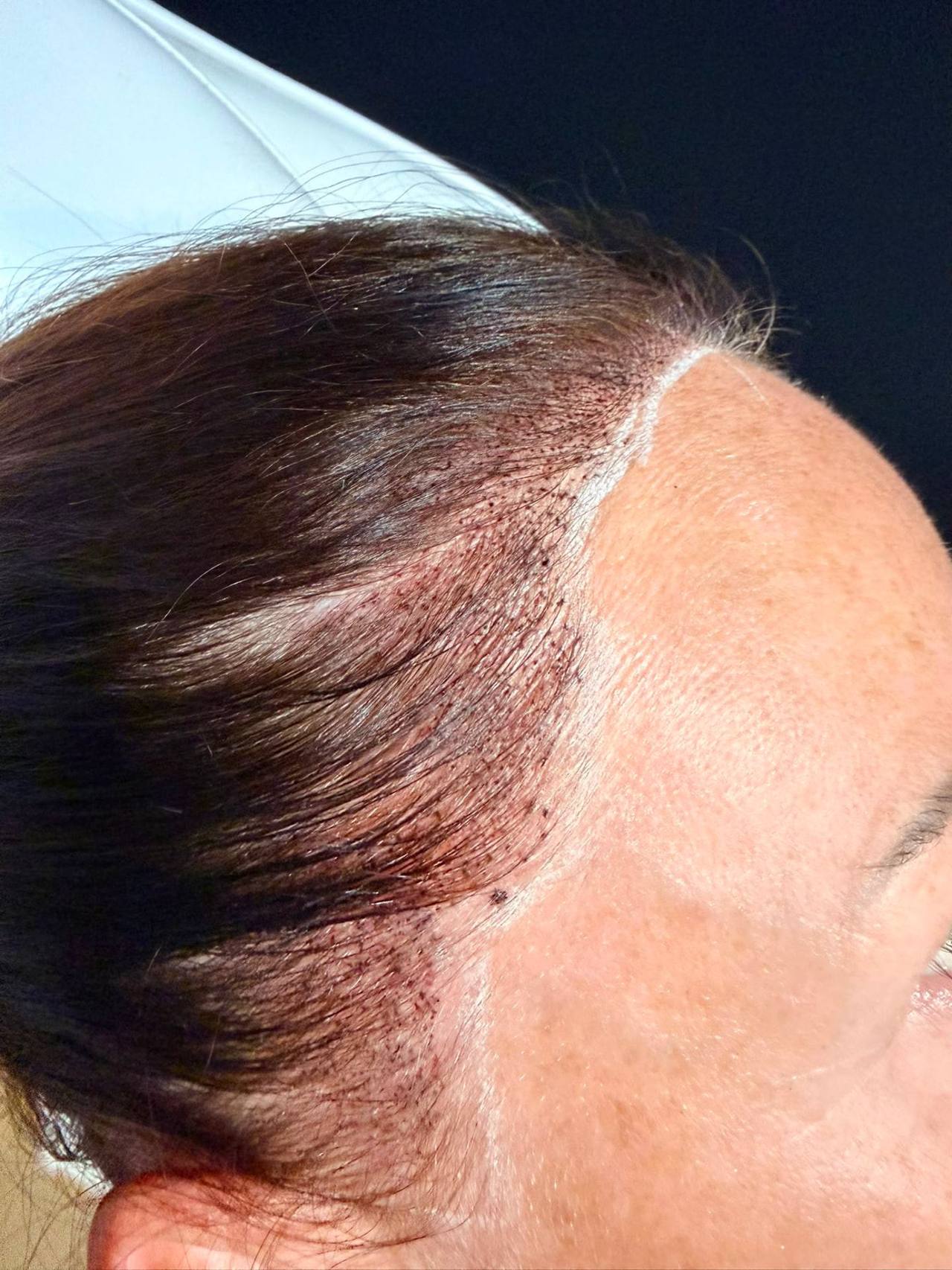 Close up of scalp micropigmentation pigment placed through a woman's thinning hairline