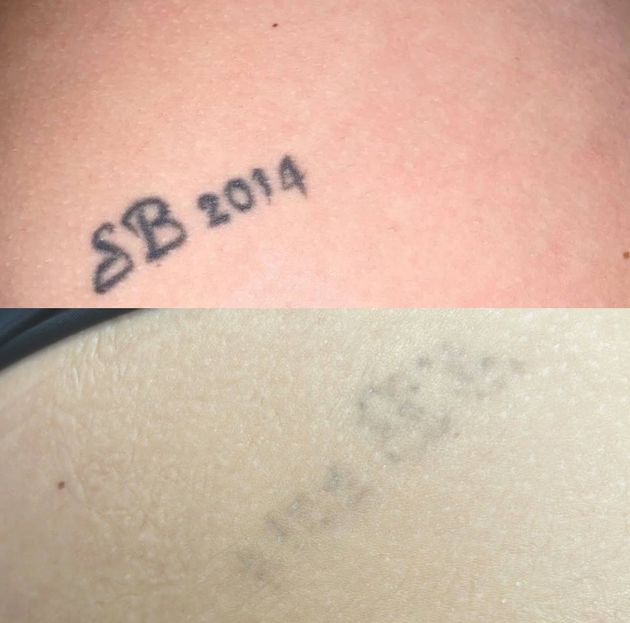 Small lettering tattoo before and after laser tattoo removal treatment