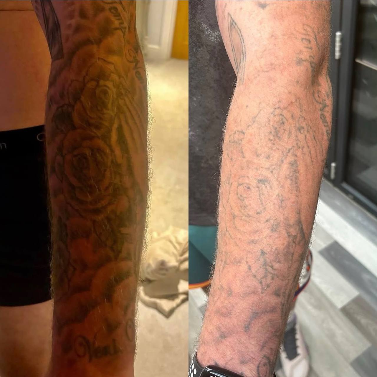 Forearm sleeve tattoo before and after Pico laser tattoo removal in Cumbria