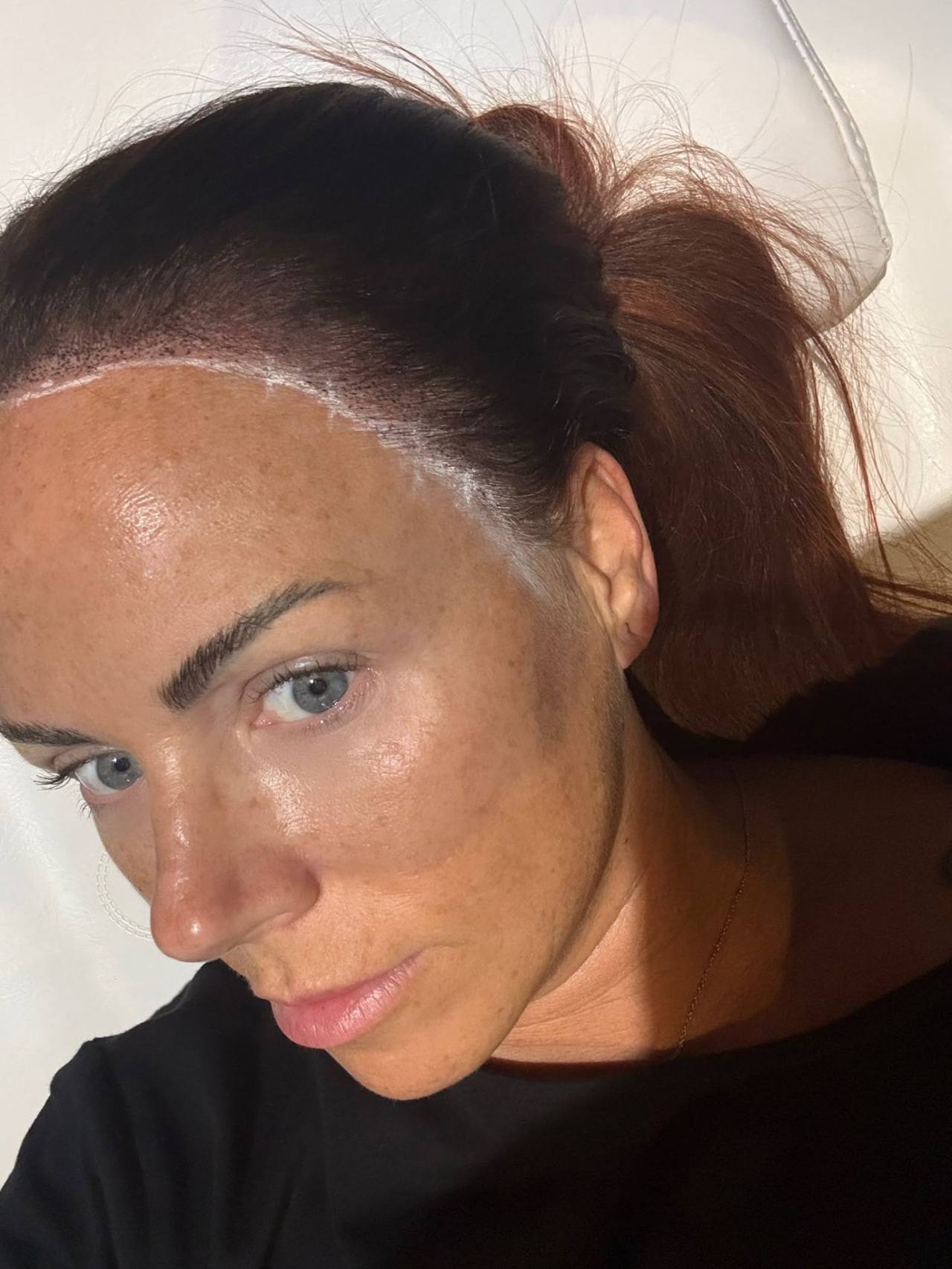 Completed female hairline restoration with scalp micropigmentation at the Workington clinic