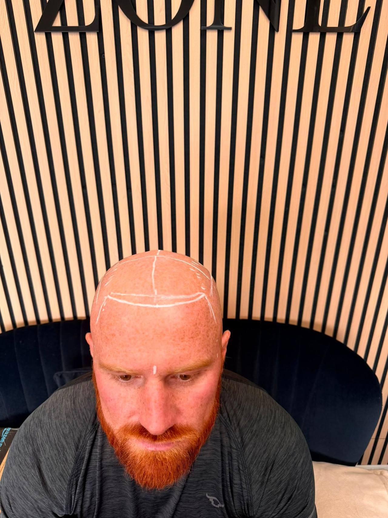 Front hairline design marked out and approved before a scalp micropigmentation session