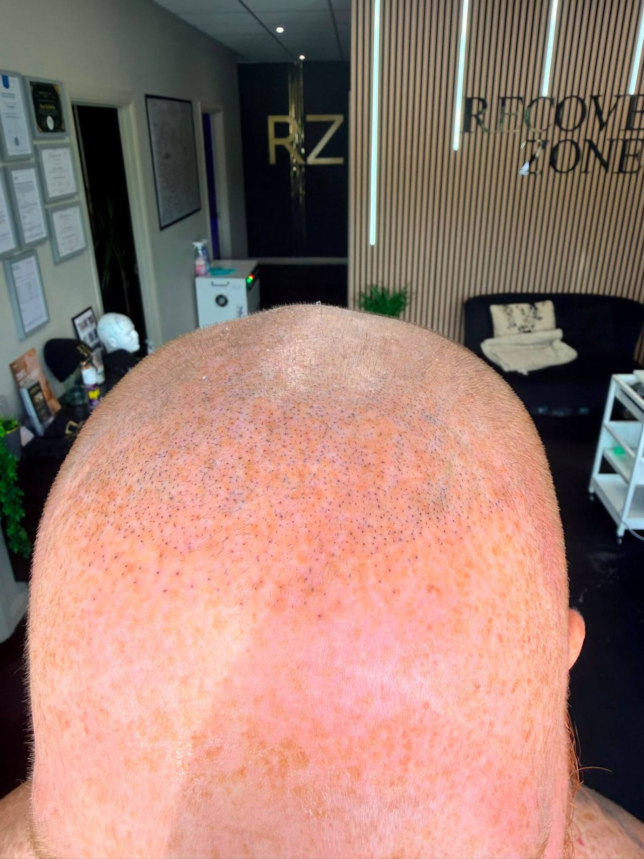 Completed scalp micropigmentation on the crown of a shaved head at Cumbria Scalp Clinic for clients in Workington